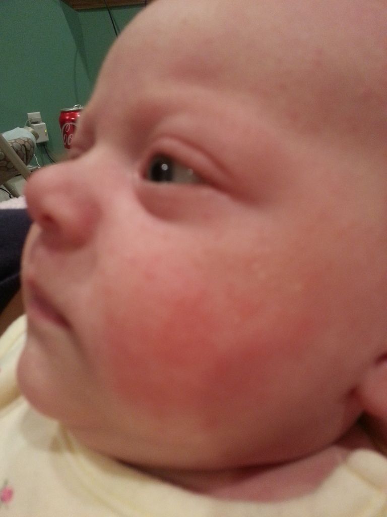 Cradle cap face rash or something else?? Pics Page 4 BabyCenter