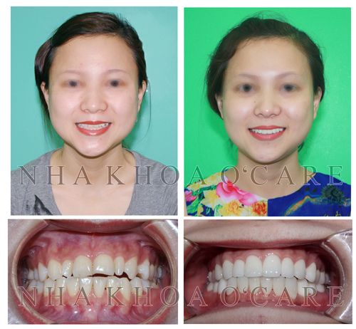 răng sứ nha khoa ocare răng sứ