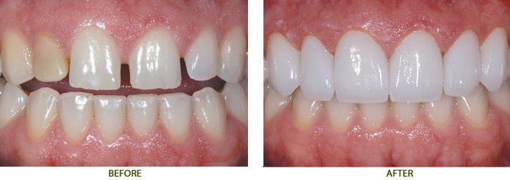 Mặt dán Veneers sứ giải pháp phục hồi thẩm mỹ răng nhanh chóng nhất.