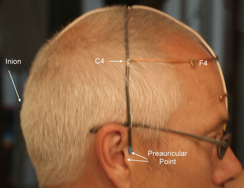 TDCS Electrode Placement Side View Photo by Modeeb Photobucket