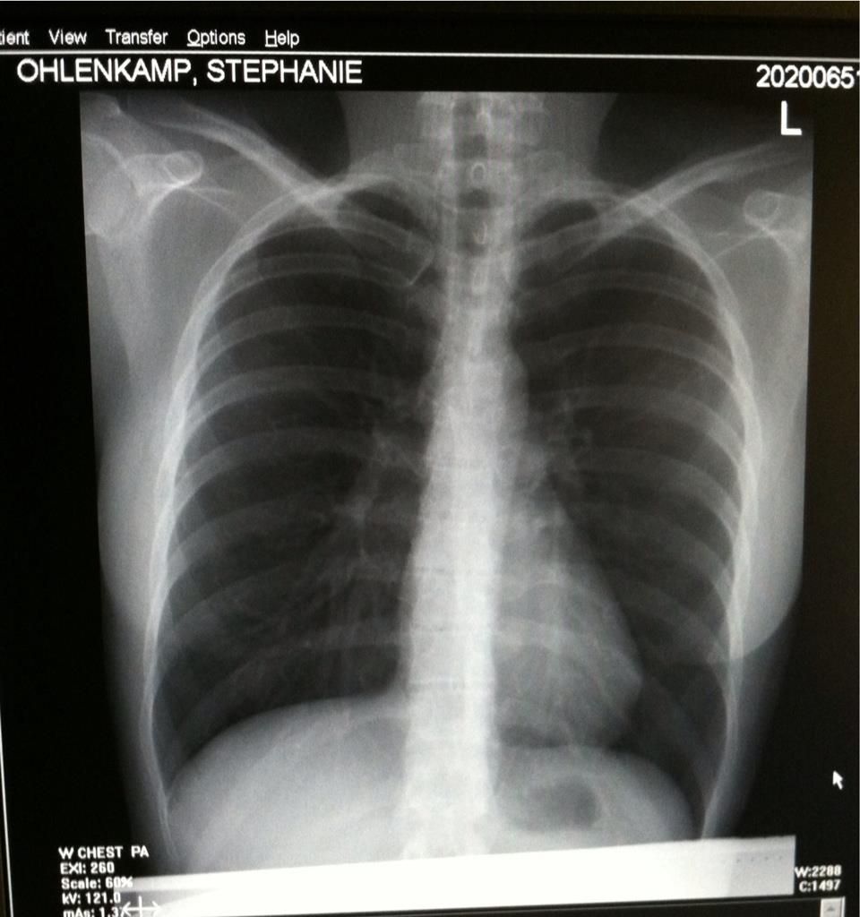Costochondritis Pictures, Images & Photos Photobucket